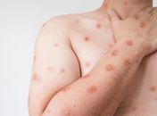 Varíola dos Macacos