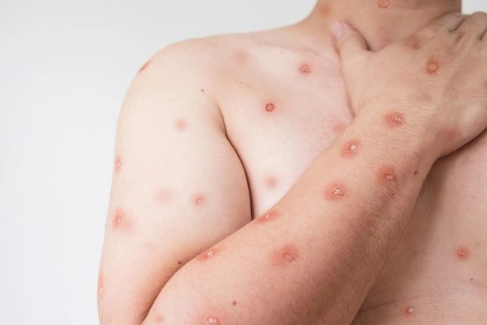 Varíola dos Macacos