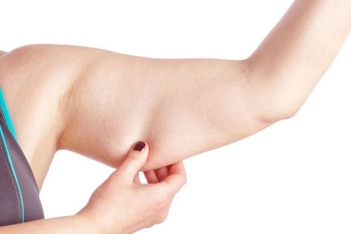 Acúmulo de gordura nas pernas e braços pode ser sinal de lipedema