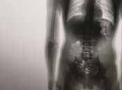 Preso é flagrado com 8 celulares, carregadores, cabos e chips dentro no corpo em MT