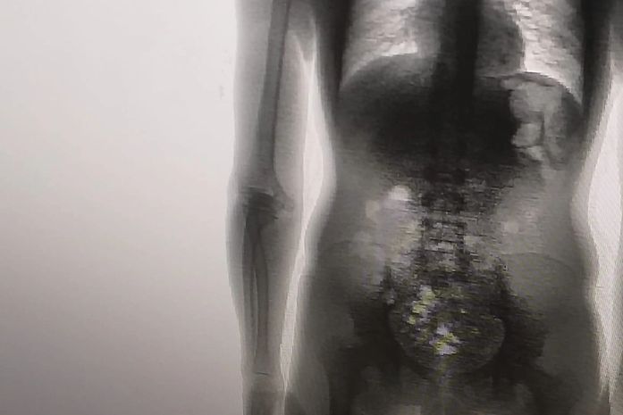 Preso é flagrado com 8 celulares, carregadores, cabos e chips dentro no corpo em MT