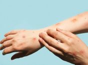 O que é mpox? Infectologista explica como reconhecer os sintomas