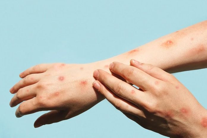 O que é mpox? Infectologista explica como reconhecer os sintomas