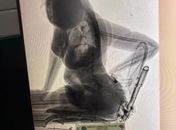 Body scanner flagra mulher com seis celulares e maconha escondidos em visita a presídio de Maceió