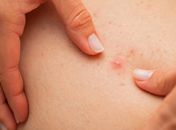 Como prevenir pelo encravado: entenda as causas e o que fazer para evitá-los