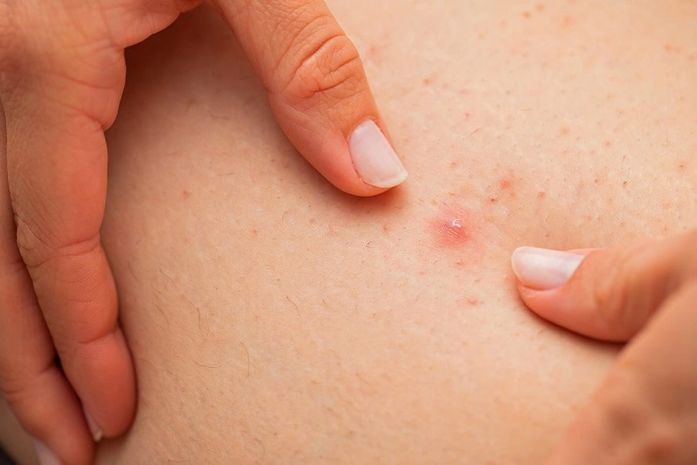 Como prevenir pelo encravado: entenda as causas e o que fazer para evitá-los