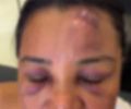 Cabeleireira denuncia agressão por policiais durante festa de São João no Benedito Bentes; caso é investigado