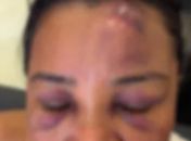 Cabeleireira denuncia agressão por policiais durante festa de São João no Benedito Bentes; caso é investigado