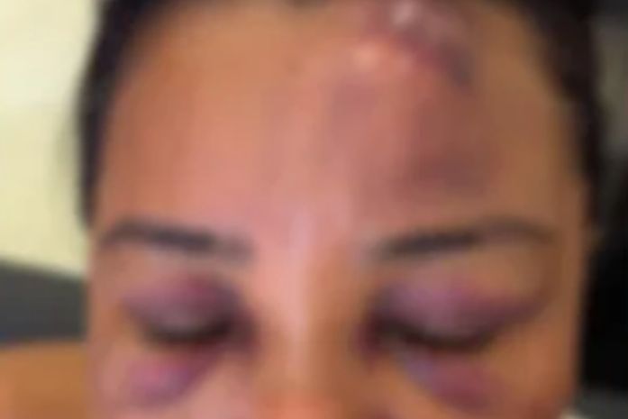 Cabeleireira denuncia agressão por policiais durante festa de São João no Benedito Bentes; caso é investigado