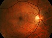 Família alagoana mobiliza campanha solidária para custear atendimento especializado de mulher diagnosticada com doença rara da visão