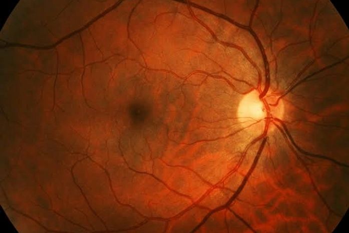 Família alagoana mobiliza campanha solidária para custear atendimento especializado de mulher diagnosticada com doença rara da visão