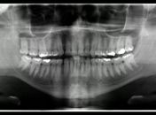 Corpo de enfermeiro do Mato Grosso é identificado após exame de odontologia legal
