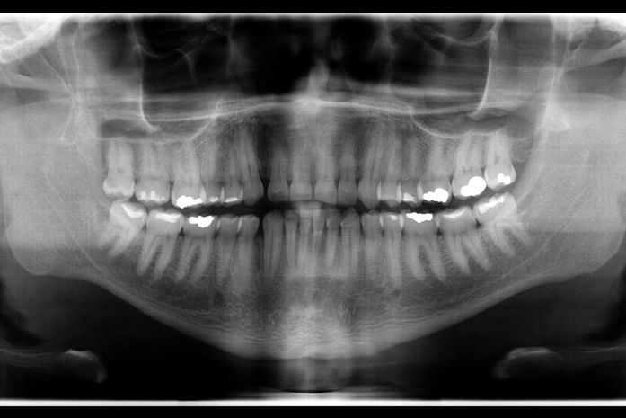 Corpo de enfermeiro do Mato Grosso é identificado após exame de odontologia legal