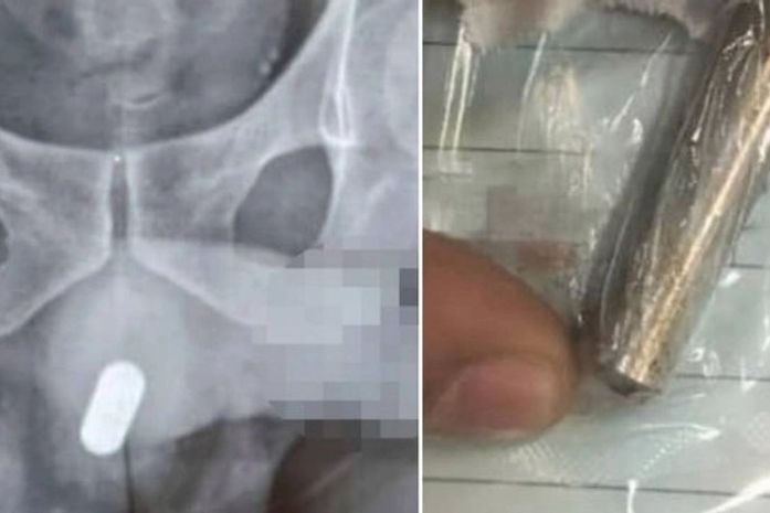 Homem é levado às pressas à emergência de hospital após inserir pilha AA no pênis