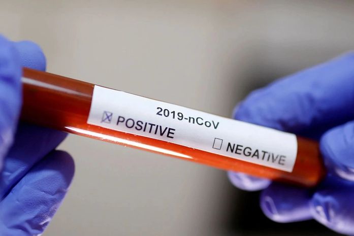 Fiocruz inicia distribuição de kits para diagnóstico do coronavírus