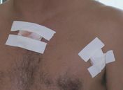 Disparo atingiu peito da vítima e saiu na axila; bala acertou placa de platina que motorista tem na clavícula.