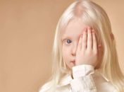 Albinismo: como abordar esta condição com nossos filhos?