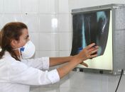 Brasil registra 78 mil novos casos de tuberculose
