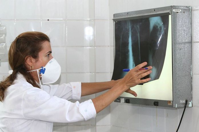 Brasil registra 78 mil novos casos de tuberculose