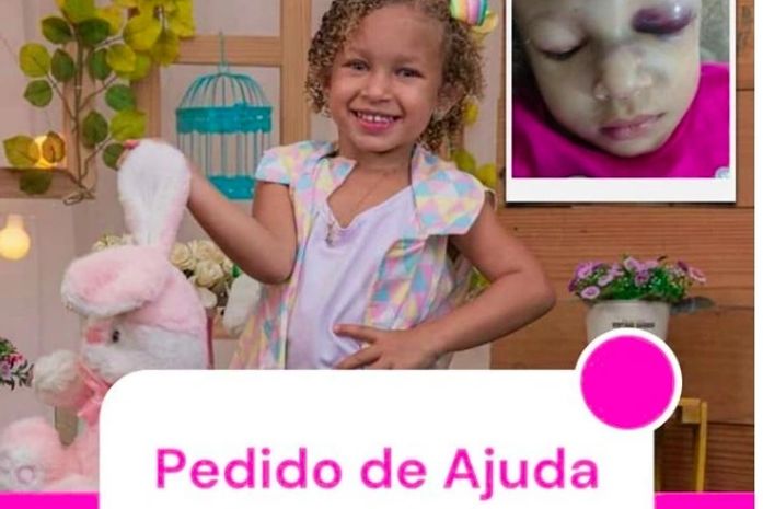 Com mobilização nas redes sociais, criança que fraturou crânio dentro de condomínio recebe cirurgia