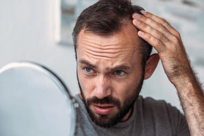 Calvície masculina: saiba quais são as principais causas