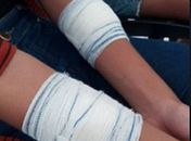 Adolescente sofreu cortes de estilete nos braços