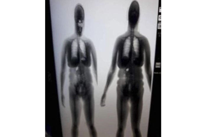 Maconha estava escondida entre as nádegas