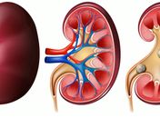 Calor intenso eleva risco de cálculo renal e acende alerta para hidratação e alimentação