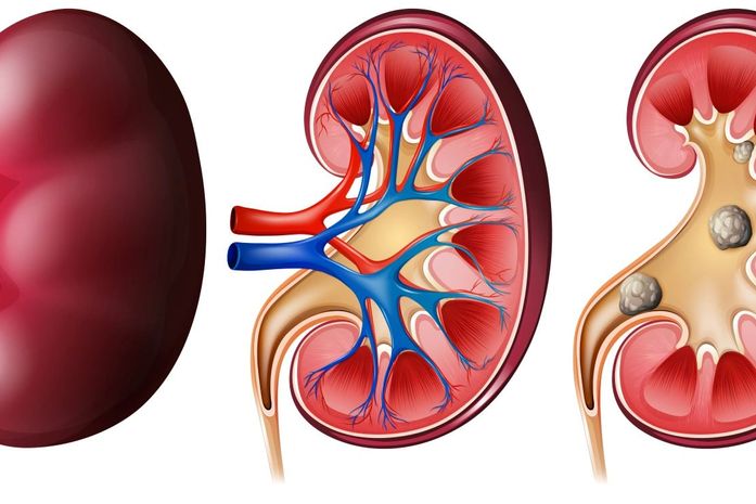 Calor intenso eleva risco de cálculo renal e acende alerta para hidratação e alimentação