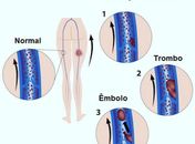 Trombose 