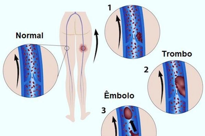 Trombose 