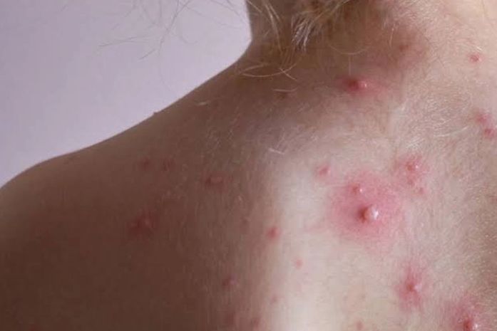 Titular da Saúde informa surto de varicela em unidade escolar no bairro Mangabeiras, em Arapiraca