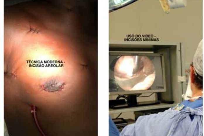 Tratamento percutâneo para CIA reduz riscos e agiliza recuperação do paciente