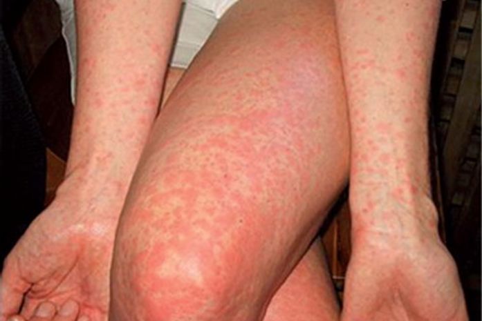 Morte de adolescente em Arapiraca acende alerta sobre dengue; especialista explica forma grave da doença