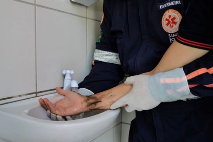 Período Junino: primeiros socorros no caso de queimadura