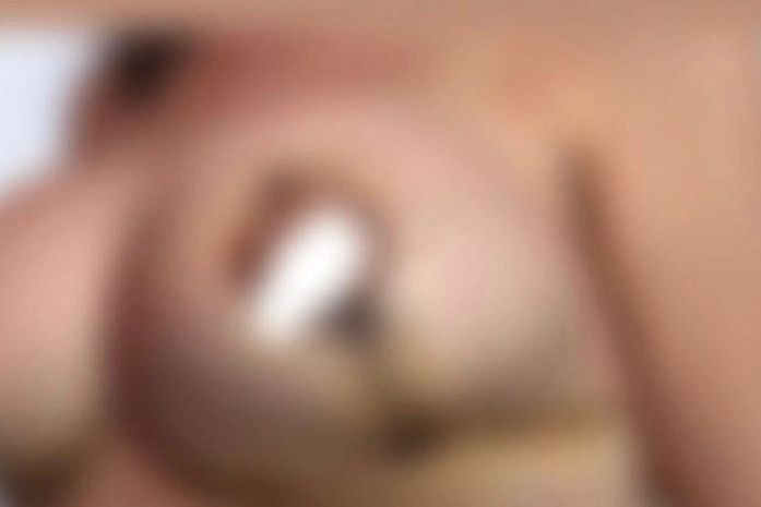 Mais de 20 mulheres denunciam suposto erro médico em cirurgias plásticas, em Maceió