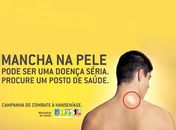  Campanha contra a Hanseníase é iniciada em São Miguel dos Campos 