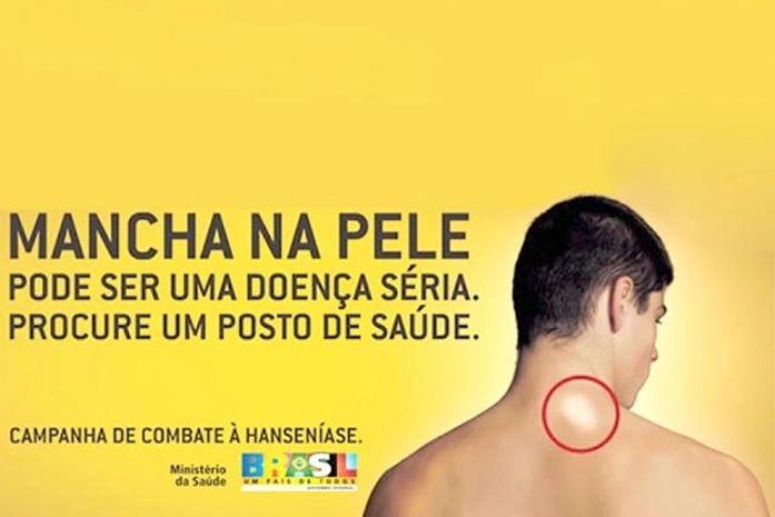 Campanha contra a Hanseníase é iniciada em São Miguel dos Campos