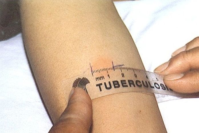 SMS realiza dois tipos de exames para diagnóstico de tuberculose