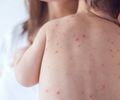 Meningite