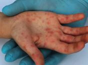 Sarampo pode fazer doente ter até pneumonia
