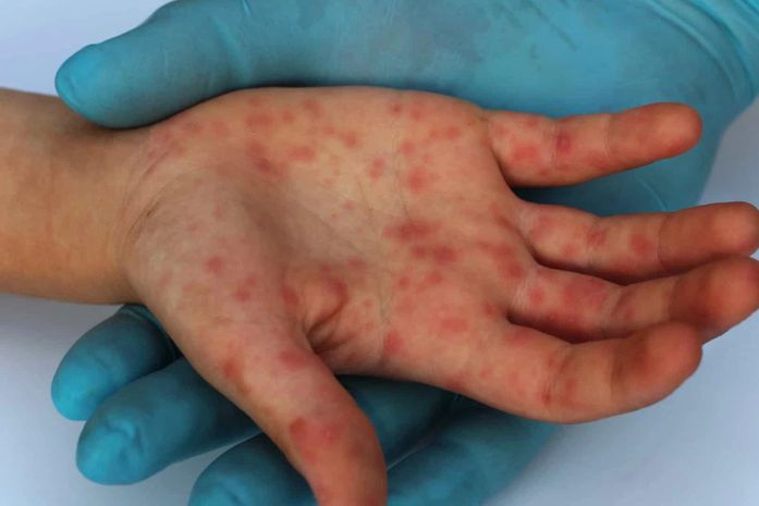 Sarampo pode fazer doente ter até pneumonia