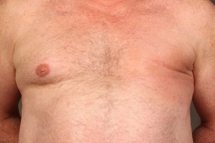 Homem após mastectomia devido ao câncer de mama