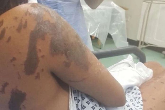 Resham teve queimaduras nos braços, pernas, rosto e ombros após o ataque