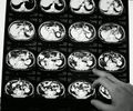 Novo medicamento para câncer colorretal metastático é aprovado no Brasil