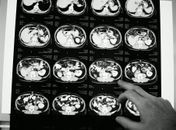 Novo medicamento para câncer colorretal metastático é aprovado no Brasil