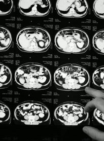 Novo medicamento para câncer colorretal metastático é aprovado no Brasil