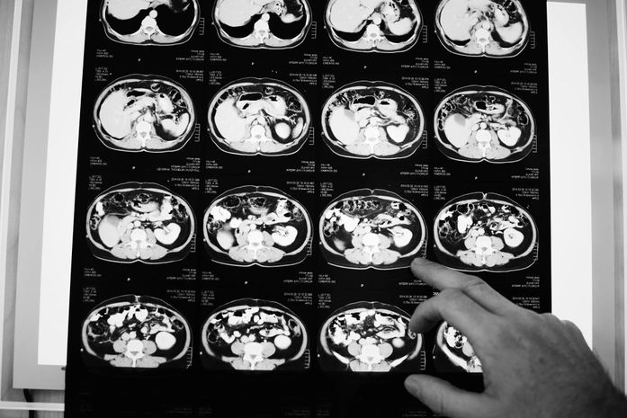 Novo medicamento para câncer colorretal metastático é aprovado no Brasil