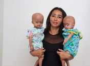 Raríssimo: conheça as gêmeas brasileiras com síndrome de Benjamin Button