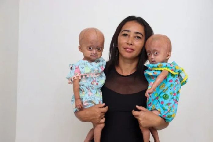 Raríssimo: conheça as gêmeas brasileiras com síndrome de Benjamin Button